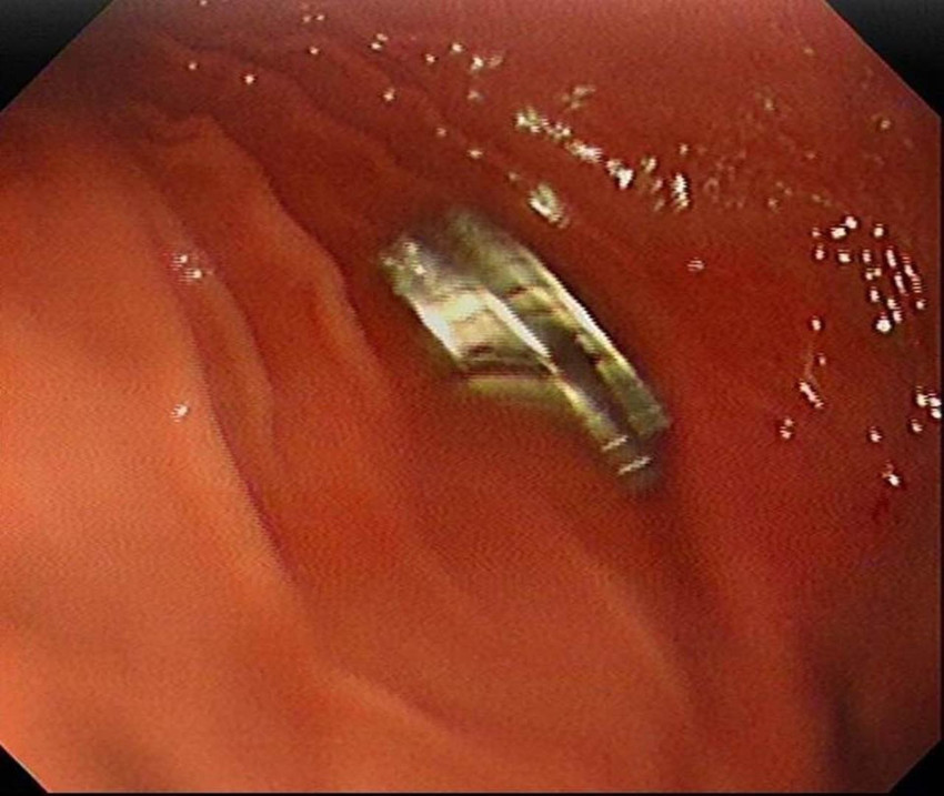 Üç yaşındaki yaramazın boğazından çıkanlar doktorları şoke etti - Resim: 4