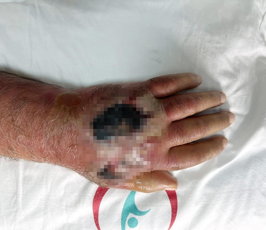 Tıp literatürüne girecek olay! Hırsız elini ısırdı, az kalsın kolunu kaybediyordu - Resim: 2