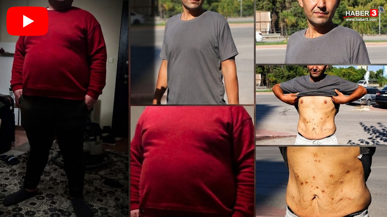 85 kilo zayıflamıştı... Tüp mide ameliyatı sonrası hayatı kabusa döndü: ''Günden güne eriyorum''